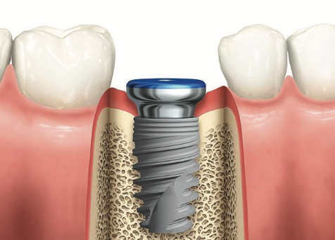 dental implant image