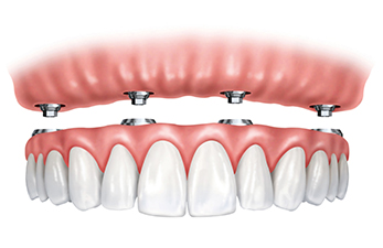 all-on-four-implants